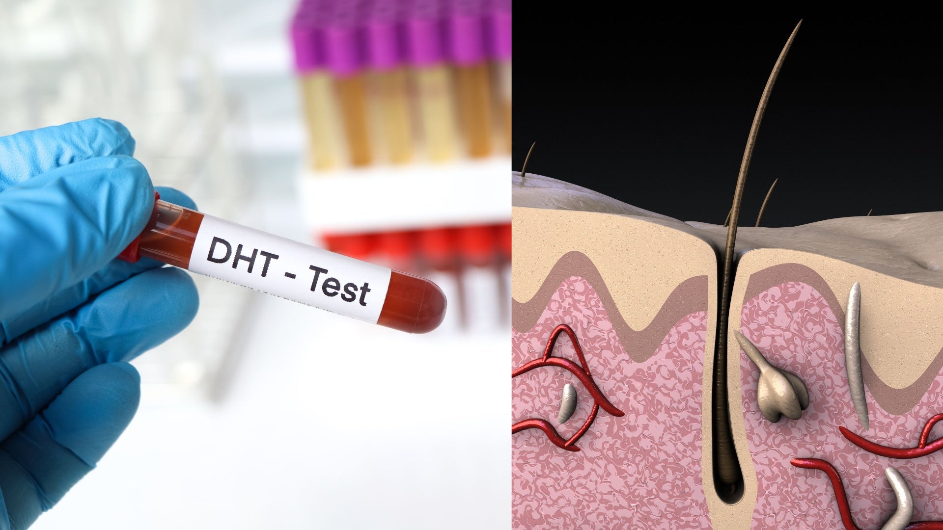 Test de DHT y diagrama del folículo capilar